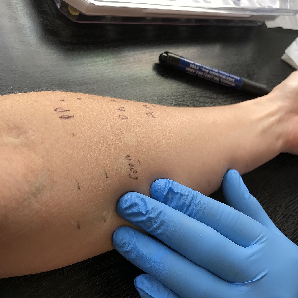 food allergy test